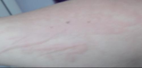 急性過(guò)敏性蕁麻疹，全面解析與應(yīng)對(duì)策略，急性過(guò)敏性蕁麻疹，全面解析及應(yīng)對(duì)指南