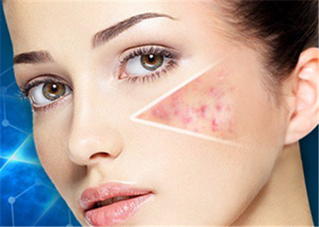 激光祛痘印大概需要多少錢呢？全面解析費(fèi)用因素與注意事項(xiàng)，激光祛痘印費(fèi)用全解析，費(fèi)用因素與注意事項(xiàng)，了解需要多少錢！