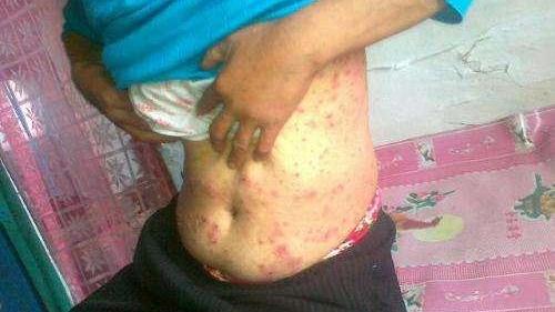 男生下面流膿，原因、應(yīng)對(duì)措施與健康提醒，男性私處流膿，原因、應(yīng)對(duì)與健康警示