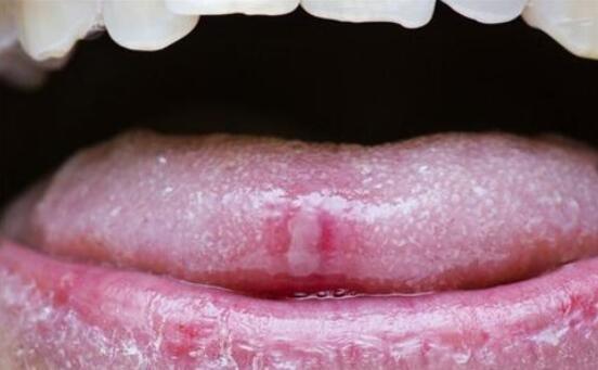 口腔粘膜炎癥，深入了解與治療策略，口腔粘膜炎癥，全面解析與治療指南