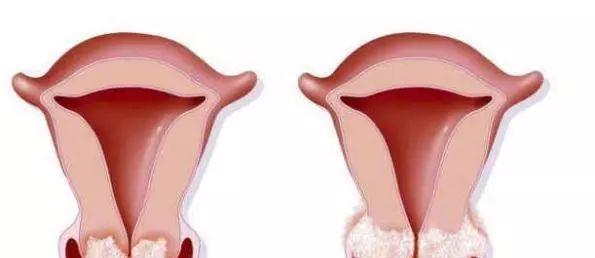 女性HPV初期感染的圖片及其相關(guān)知識科普，女性HPV初期感染圖片與知識科普，了解、預防與治療