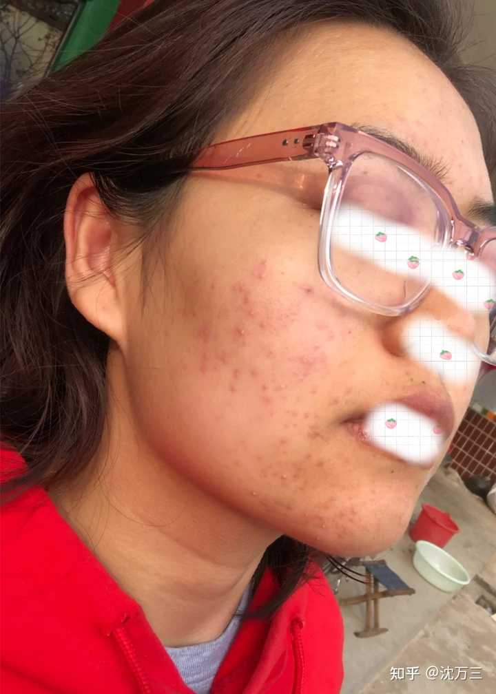 消除痤瘡留下的紅色痘印的有效方法，消除紅色痘印，痤瘡后的護(hù)膚秘訣