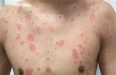 晚上發(fā)作的蕁麻疹名稱及其相關(guān)知識解析，夜間蕁麻疹發(fā)作解析，癥狀、原因與知識科普