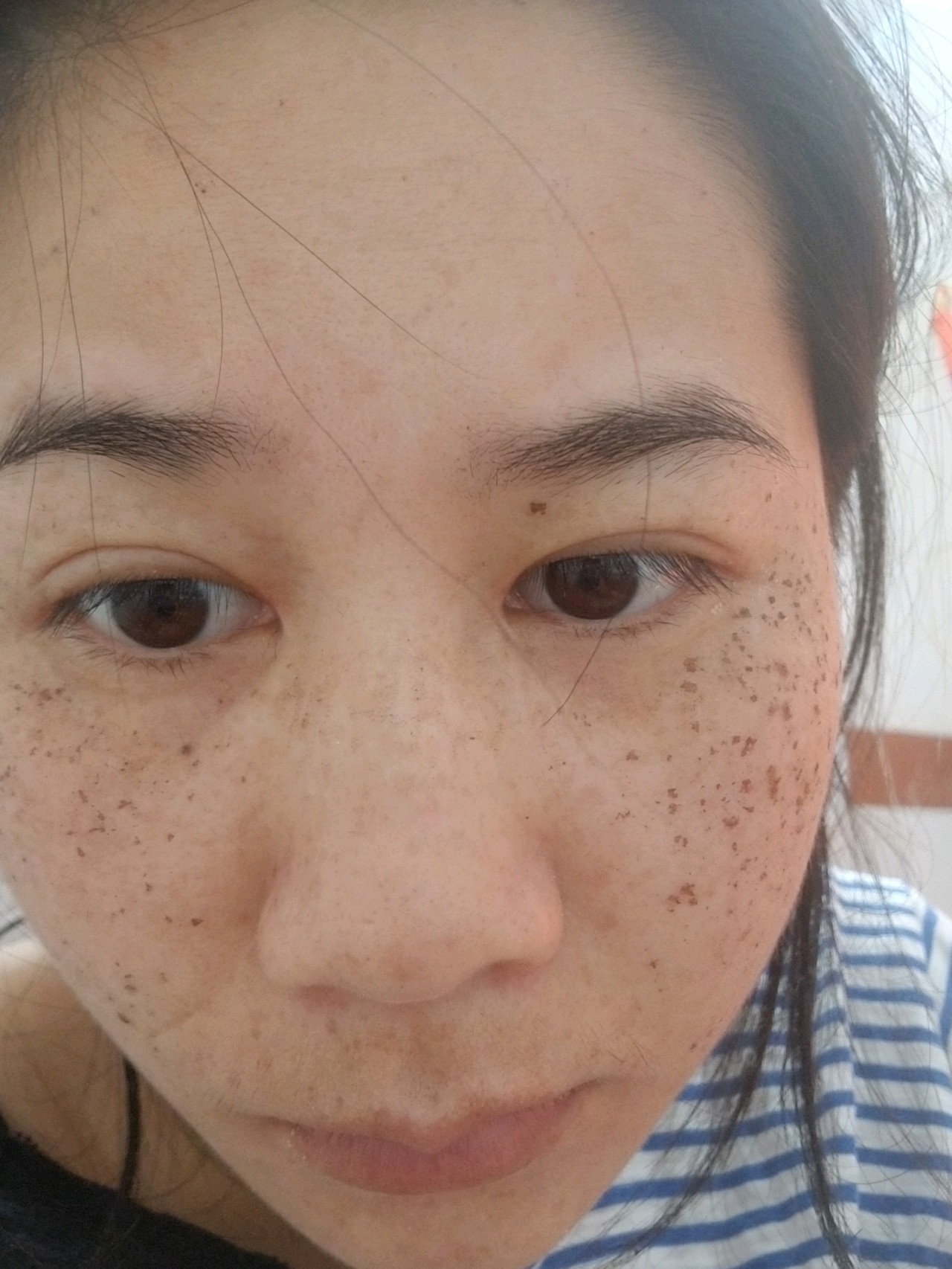 激光祛斑后的15天，見證肌膚煥變的瞬間，激光祛斑后15天，肌膚煥新瞬間見證