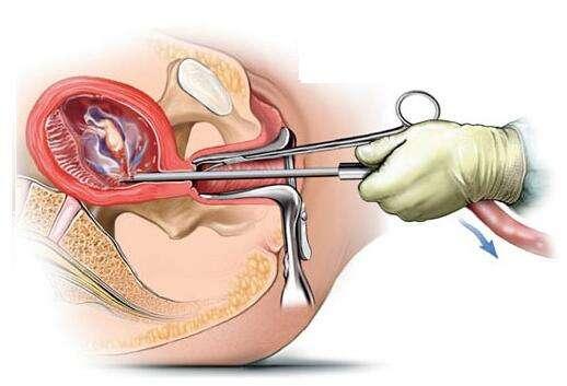 流產(chǎn)最小的傷害是哪一種，探討不同流產(chǎn)方式的利弊與選擇策略，探討不同流產(chǎn)方式的利弊，尋找最小傷害的選擇策略