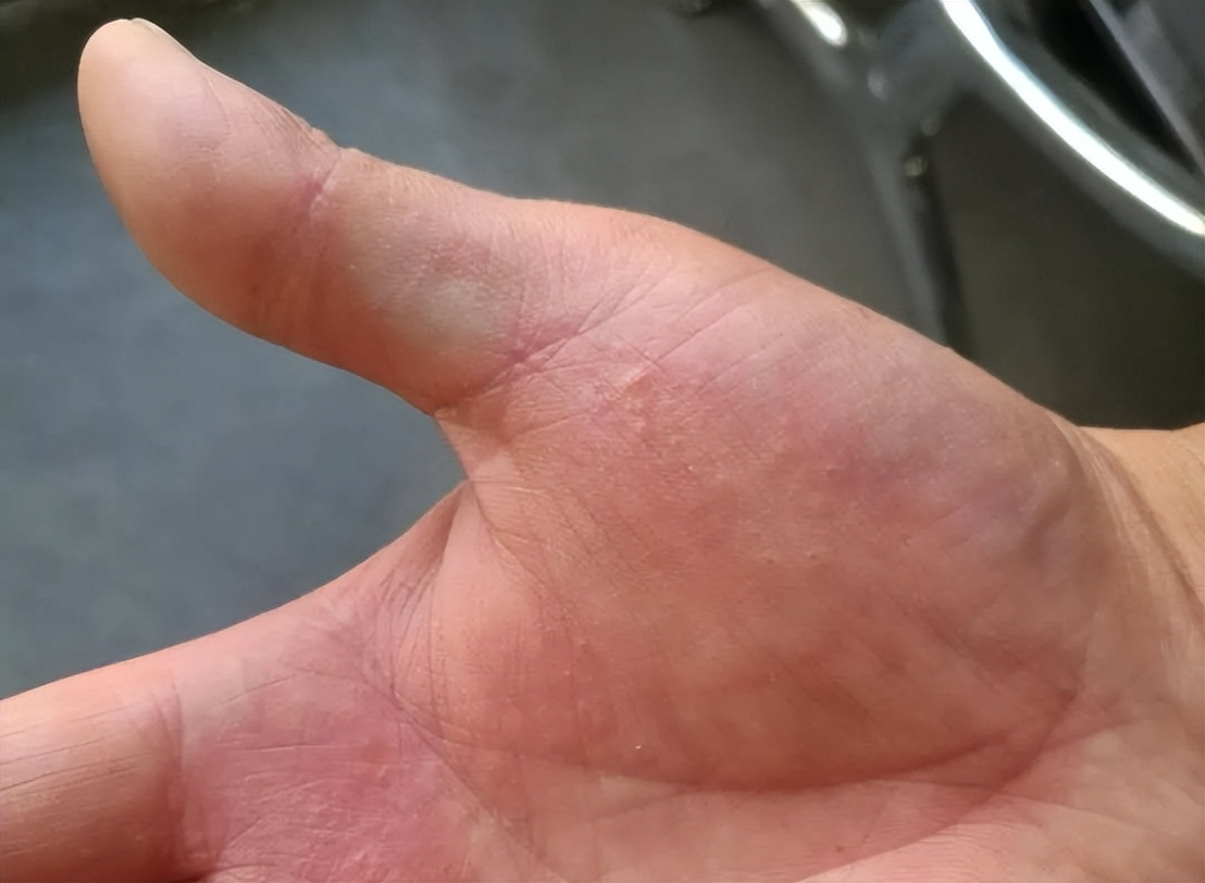 手上起小水泡圖片，原因、治療與預(yù)防，手上起小水泡，圖片詳解、成因、治療與預(yù)防方法