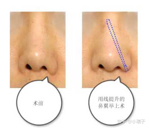 縮小鼻翼的方法，有效改善鼻翼過(guò)大的實(shí)用指南，縮小鼻翼的有效方法，實(shí)用指南助你改善鼻翼過(guò)大問(wèn)題