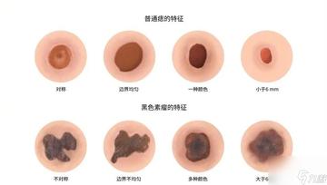 正常痣與黑色素瘤圖片，了解二者的區(qū)別與識(shí)別方法，正常痣與黑色素瘤圖片對(duì)比，區(qū)分與識(shí)別方法指南