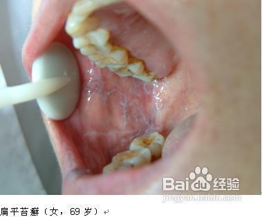 口腔扁平苔蘚，了解、預防與治療，口腔扁平苔蘚，了解、預防與治療全攻略