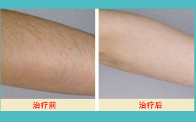 激光脫毛的價格解析，多少錢才能擁有絲滑肌膚？，激光脫毛價格詳解，多少錢能擁有絲滑肌膚？