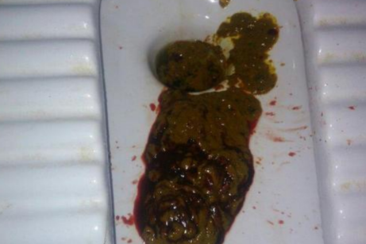 拉屎拉出鮮紅的血不痛，原因分析及應對措施，無痛性鮮紅便血原因解析與應對方案