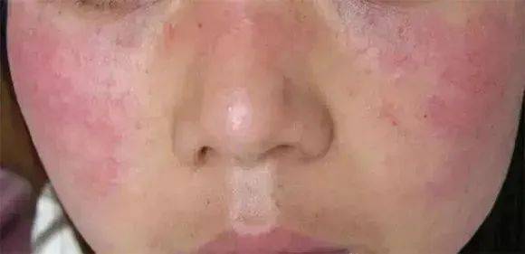 臉過(guò)敏發(fā)紅癢怎么辦——臉部過(guò)敏急救指南，臉部過(guò)敏發(fā)紅癢怎么辦？急救指南助你快速緩解不適！