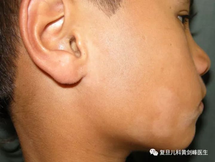 白色糠疹，了解、預(yù)防與治療，白色糠疹，全面解析、預(yù)防與治療方法