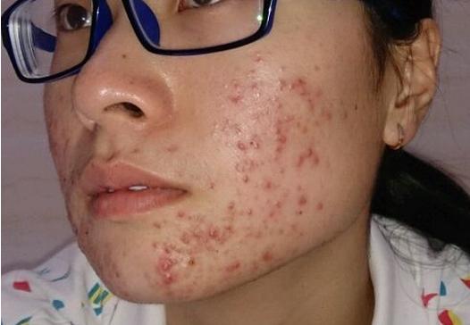 如何去除青春痘，男生的護(hù)膚指南，男生護(hù)膚指南，如何有效去除青春痘