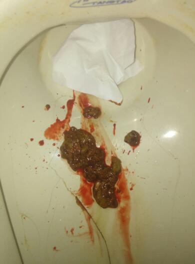 上大號(hào)拉出血怎么回事——解析便血的可能原因與應(yīng)對(duì)措施，解析，大便出血的原因及應(yīng)對(duì)措施