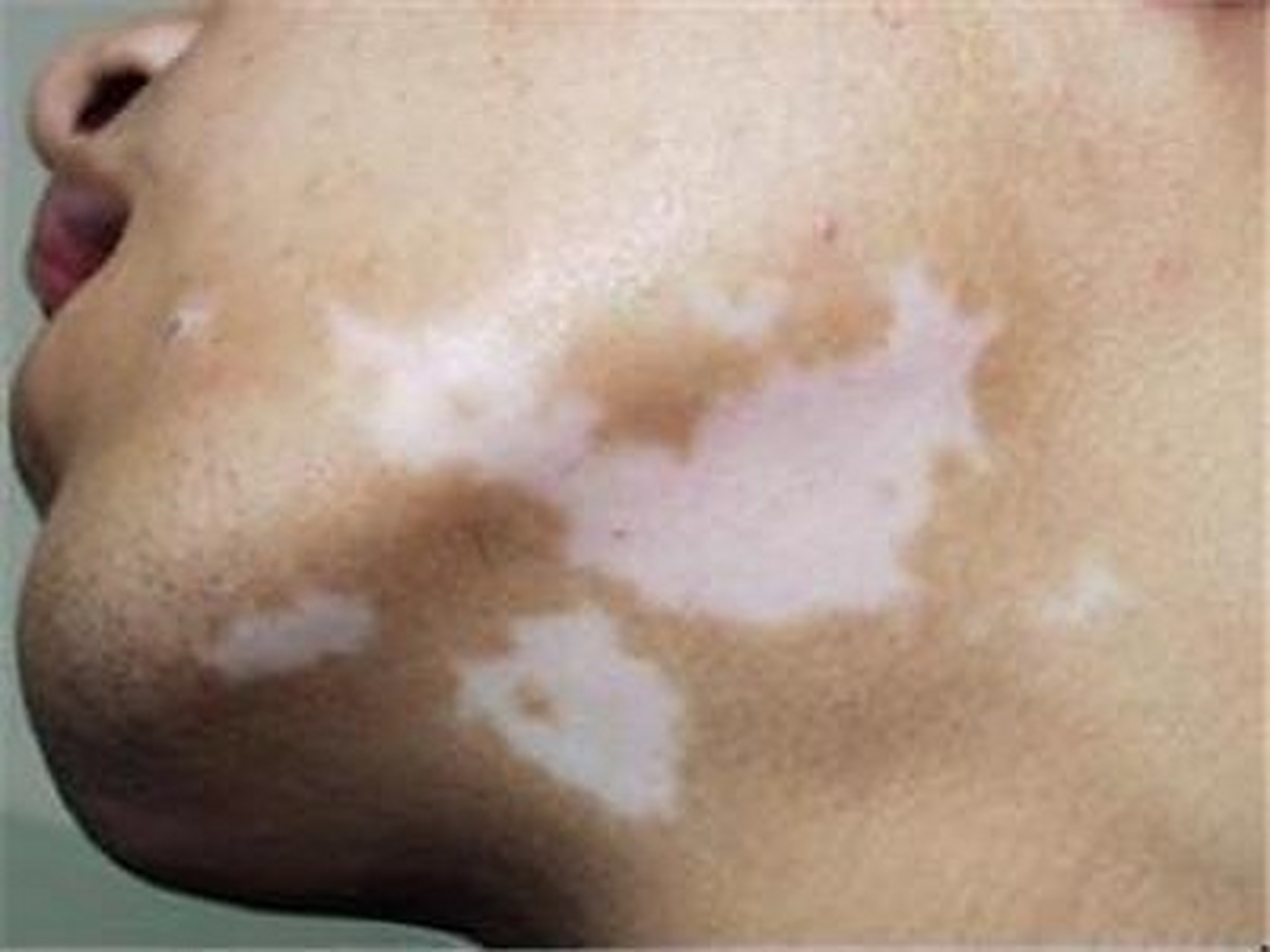 白點癲風(fēng)怎么治療效果最好，全面解析最佳治療方案，全面解析白點癲風(fēng)最佳治療方案，治療效果最大化