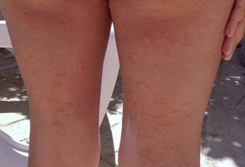 蕁麻疹的治療方法，全方位解析與應(yīng)對(duì)策略，全方位解析蕁麻疹治療方法與應(yīng)對(duì)策略