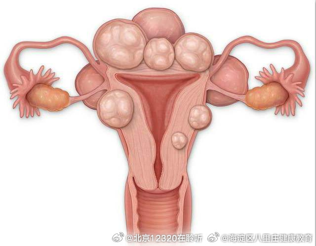 子宮肌瘤的最佳治療方法，全面解析與指導(dǎo)，子宮肌瘤的最佳治療方法詳解與指導(dǎo)手冊(cè)