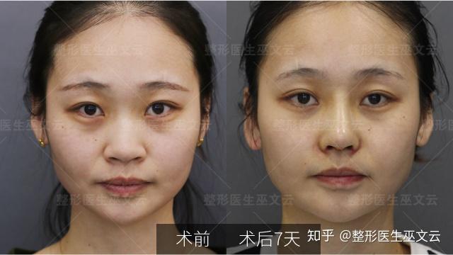 縮鼻翼手術，重塑美麗鼻型的最佳選擇，縮鼻翼手術，重塑美麗鼻型的優(yōu)選之道