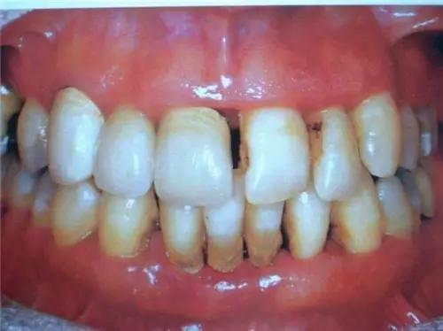 牙齦萎縮初期圖片及其相關知識解析，牙齦萎縮初期圖片與相關知識詳解