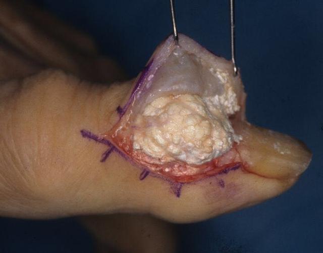 痛風(fēng)結(jié)晶溶解時間，影響因素與應(yīng)對策略，痛風(fēng)結(jié)晶溶解的時間、影響因素及應(yīng)對策略詳解