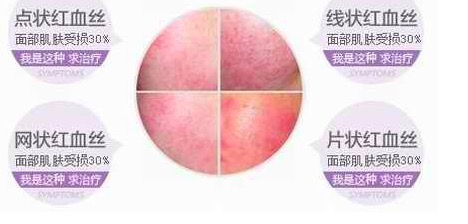 淡化紅血絲的小竅門，實(shí)用方法與日常護(hù)理建議，淡化紅血絲的小妙招，實(shí)用方法與日常護(hù)理建議