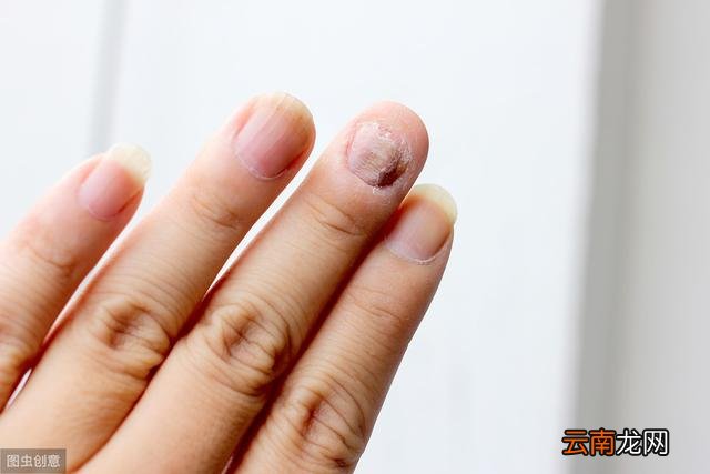 如何判斷自己是否患有灰指甲，如何判斷自己是否患有灰指甲？判斷標(biāo)準(zhǔn)與防治方法解析