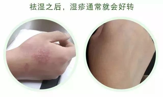 一般濕疹多久會消失，深入了解濕疹及其消失時間因素，濕疹消失時間解析，影響因素與深度了解