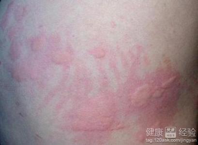 急性蕁麻疹會傳染嗎？解析蕁麻疹的真相與誤區(qū)，急性蕁麻疹是否會傳染？真相解析與誤區(qū)探討