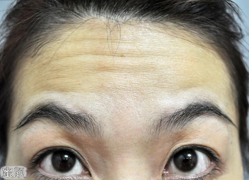 消除抬頭紋最簡單方法，實用指南與技巧，消除抬頭紋的有效方法與實用指南