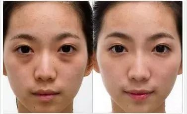 如何有效淡化黑眼圈和眼袋——全方位指南，全方位指南，黑眼圈與眼袋淡化秘籍