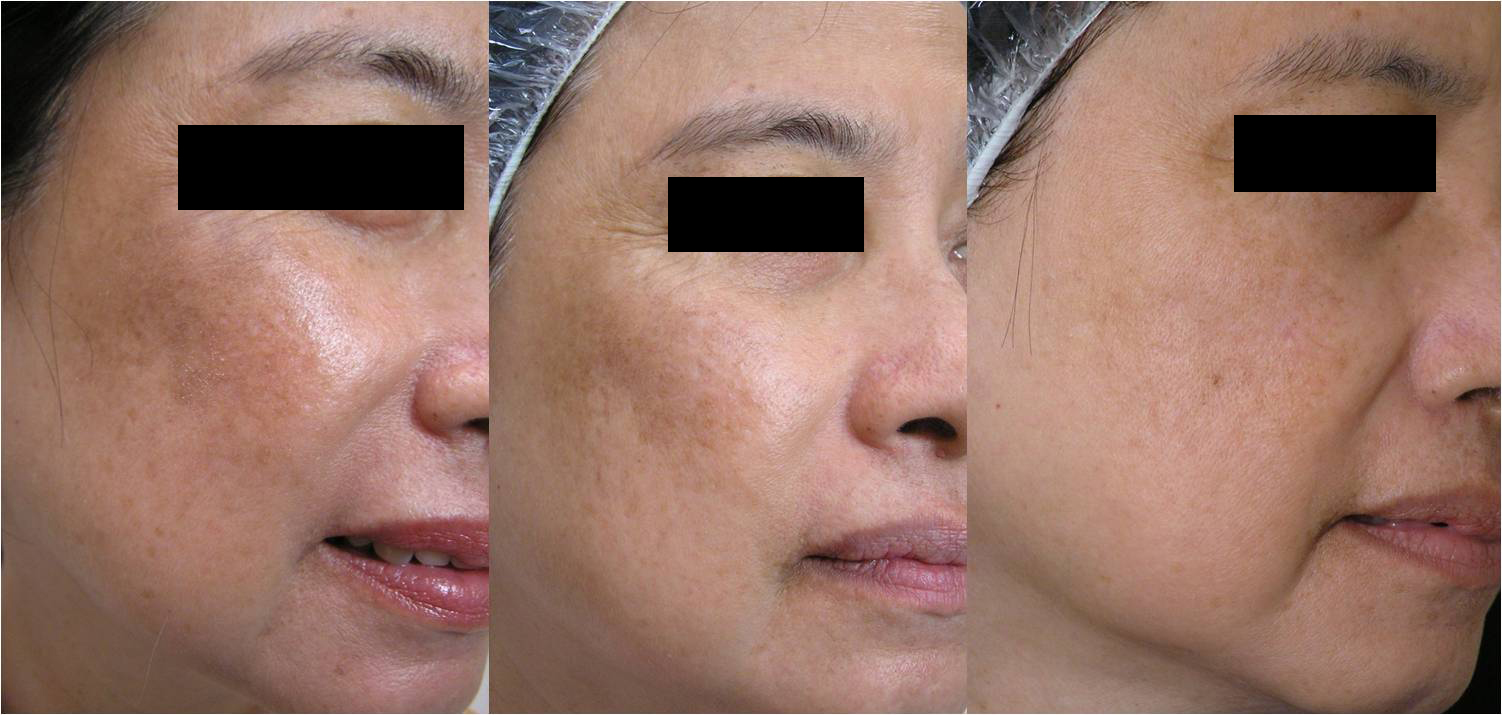 黃褐斑怎么才能去掉？——全方位解析黃褐斑去除方法，全方位解析，如何有效去除黃褐斑？