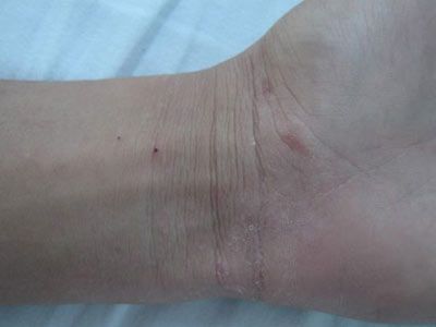 疥瘡圖片和癥狀，全面了解疥瘡，助力健康防護(hù)，全面了解疥瘡，癥狀與圖片解析，助力健康防護(hù)